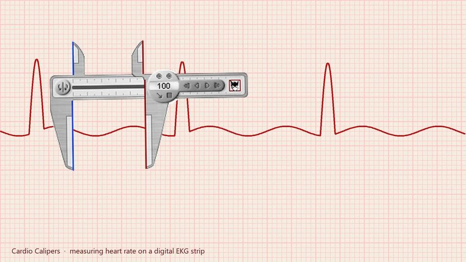 Calculating Heart Rate from Irregular ECG Tracings: Digital vs. Manual