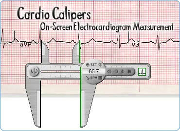 Cardio Calipers measuring an EKG